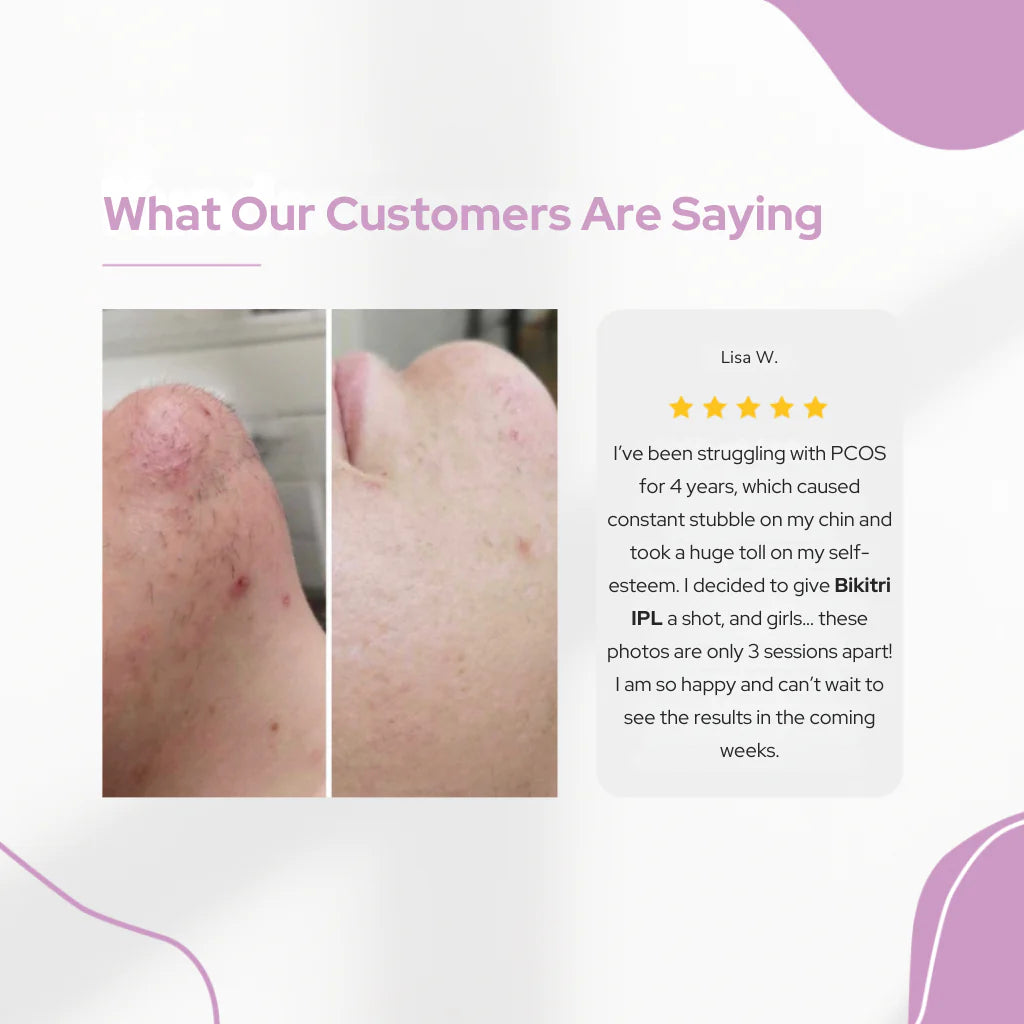 Professional IPL Laser Hair Removal Device